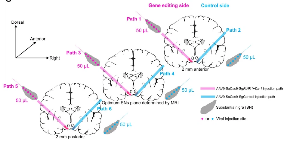 Schematic showing of three parallel paths (pink lines 1, 3, and 5) of AAV9-SaCas9- SgPINK1?DJ-1 injections containing 18 injection sites that cover the left SN, and three parallel paths (blue lines 2, 4, and 6) of AAV9- SaCas9-SgControl injections containing 18 injection sites. Schematic showing of three parallel paths (pink lines 1, 3, and 5) of AAV9-SaCas9- SgPINK1?DJ-1 injections containing 18 injection sites that cover the left SN, and three parallel paths (blue lines 2, 4, and 6) of AAV9- SaCas9-SgControl injections containing 18 injection sites.
