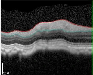 Glaucoma Nonhuman Primates Disease Model