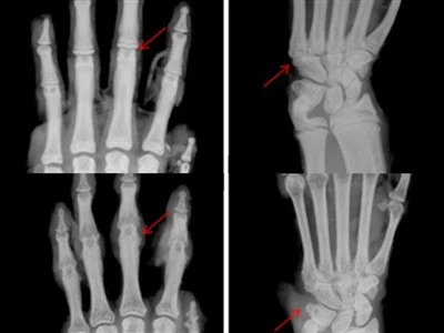 Rheumatoid Arthritis (RA) model